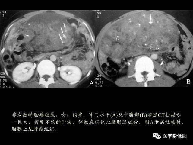 【PPT】卵巢肿瘤CT影像诊断