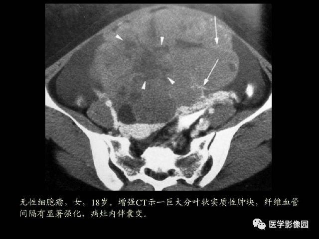 【PPT】卵巢肿瘤CT影像诊断
