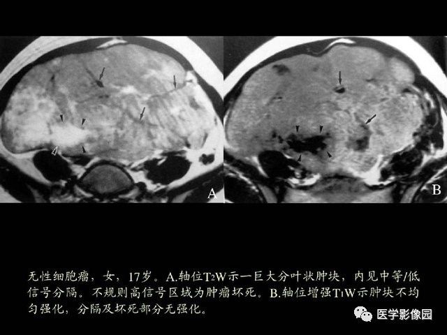 【PPT】卵巢肿瘤CT影像诊断