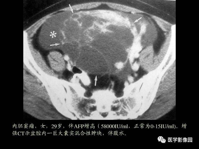 【PPT】卵巢肿瘤CT影像诊断