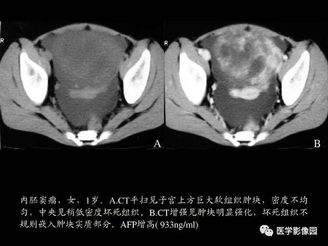 【PPT】卵巢肿瘤CT影像诊断