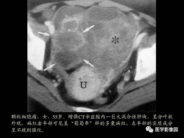 【PPT】卵巢肿瘤CT影像诊断