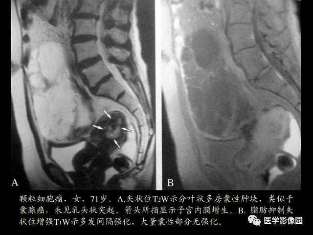 【PPT】卵巢肿瘤CT影像诊断
