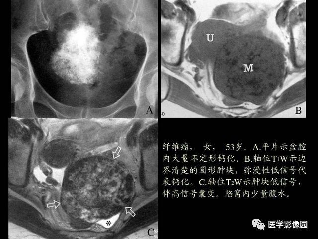 【PPT】卵巢肿瘤CT影像诊断