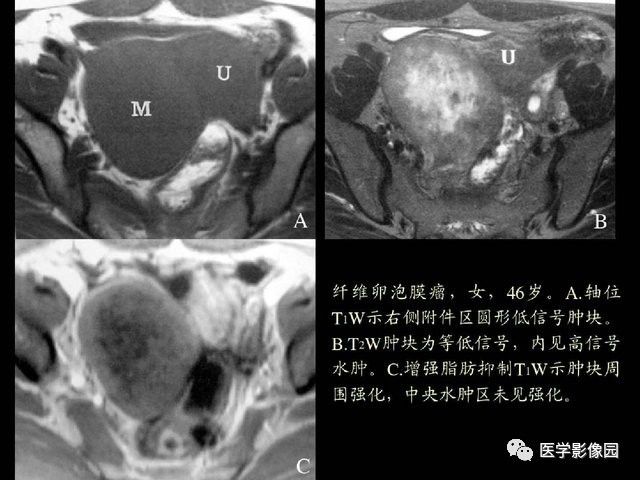 【PPT】卵巢肿瘤CT影像诊断