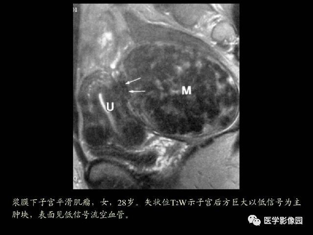 【PPT】卵巢肿瘤CT影像诊断