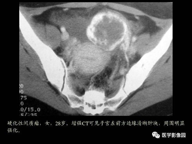 【PPT】卵巢肿瘤CT影像诊断