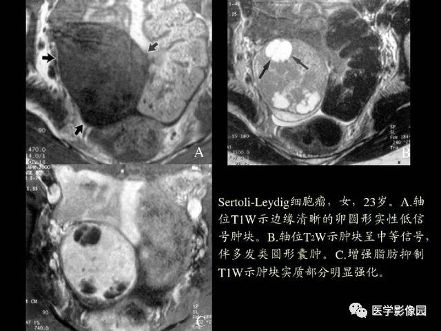【PPT】卵巢肿瘤CT影像诊断