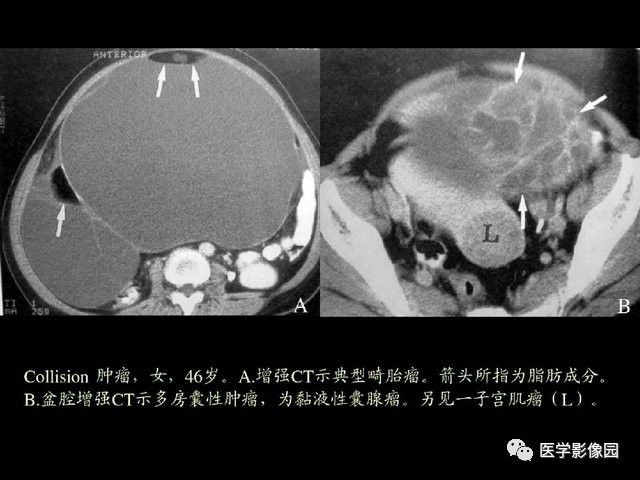 【PPT】卵巢肿瘤CT影像诊断