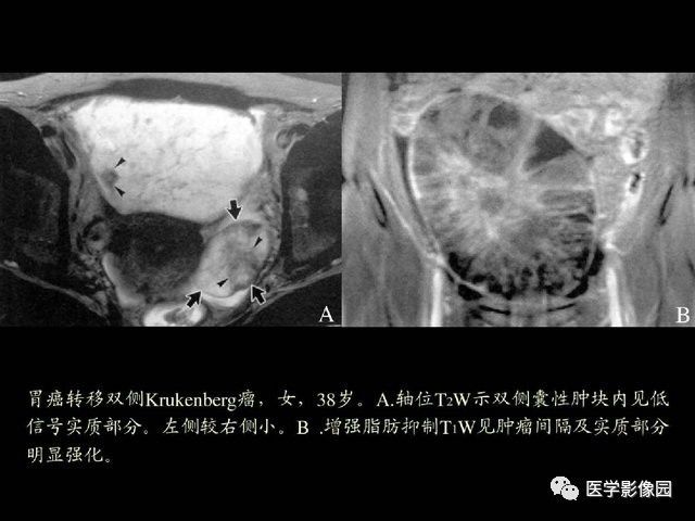 【PPT】卵巢肿瘤CT影像诊断