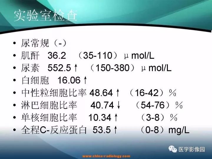 【病例】肾母细胞瘤1例CT影像表现 【病例】肾母细胞瘤1例CT影像表现