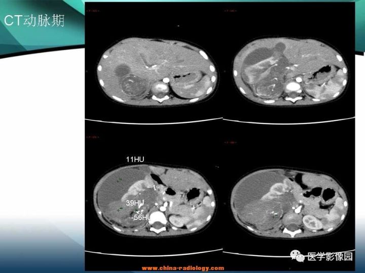 【病例】肾母细胞瘤1例CT影像表现 【病例】肾母细胞瘤1例CT影像表现
