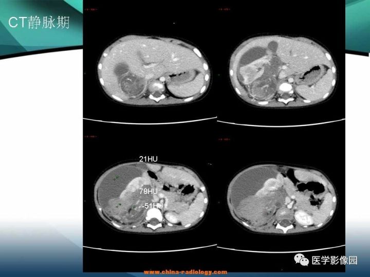 【病例】肾母细胞瘤1例CT影像表现 【病例】肾母细胞瘤1例CT影像表现