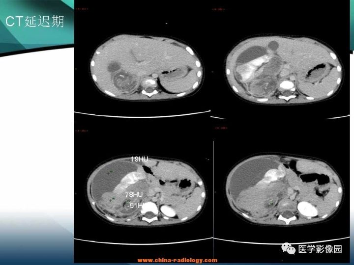 【病例】肾母细胞瘤1例CT影像表现 【病例】肾母细胞瘤1例CT影像表现
