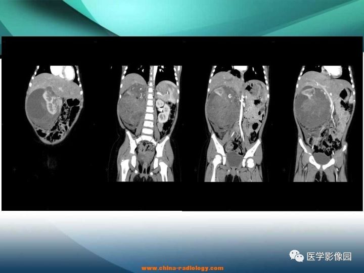【病例】肾母细胞瘤1例CT影像表现 【病例】肾母细胞瘤1例CT影像表现