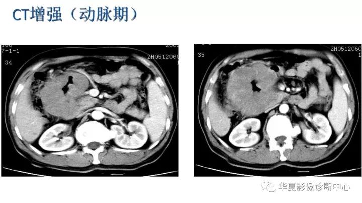 【病例】小肠间质瘤？淋巴瘤？