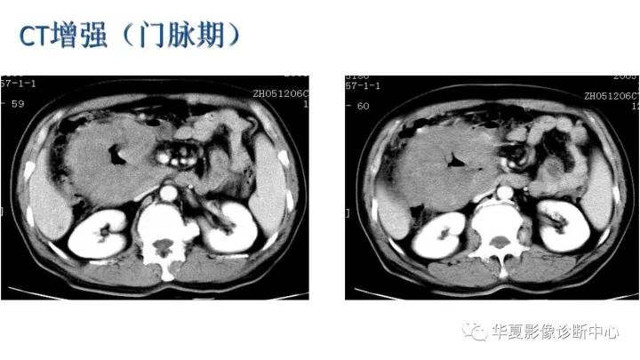 【病例】小肠间质瘤？淋巴瘤？