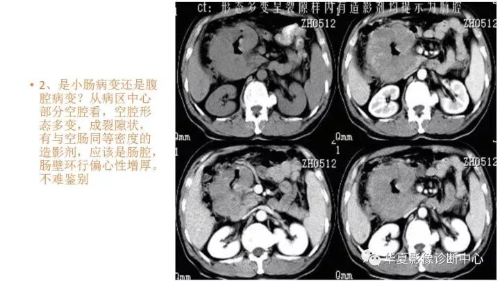 【病例】小肠间质瘤？淋巴瘤？