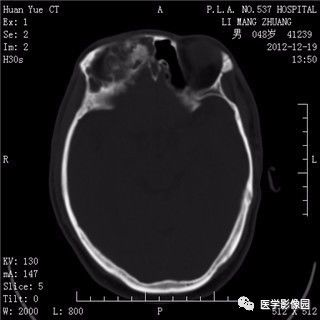 【病例】鼻窦乳头状瘤1例CT及MR影像表现 【病例】鼻窦乳头状瘤1例CT及MR影像表现