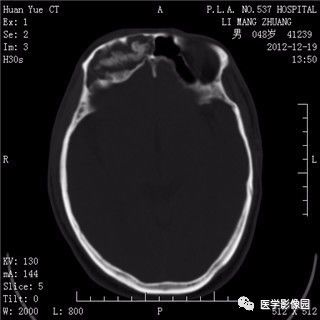 【病例】鼻窦乳头状瘤1例CT及MR影像表现 【病例】鼻窦乳头状瘤1例CT及MR影像表现