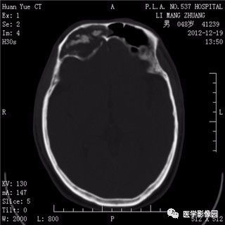 【病例】鼻窦乳头状瘤1例CT及MR影像表现 【病例】鼻窦乳头状瘤1例CT及MR影像表现