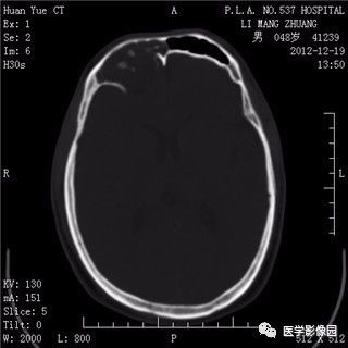 【病例】鼻窦乳头状瘤1例CT及MR影像表现 【病例】鼻窦乳头状瘤1例CT及MR影像表现