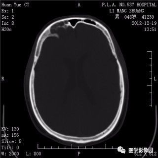 【病例】鼻窦乳头状瘤1例CT及MR影像表现 【病例】鼻窦乳头状瘤1例CT及MR影像表现