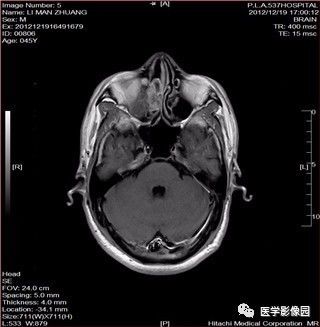 【病例】鼻窦乳头状瘤1例CT及MR影像表现 【病例】鼻窦乳头状瘤1例CT及MR影像表现