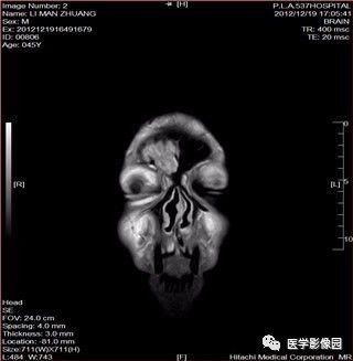 【病例】鼻窦乳头状瘤1例CT及MR影像表现 【病例】鼻窦乳头状瘤1例CT及MR影像表现