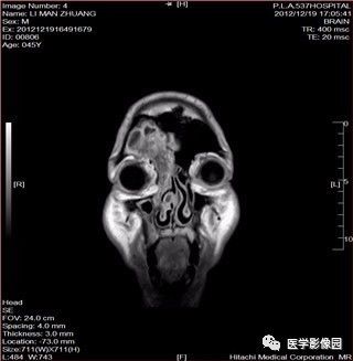 【病例】鼻窦乳头状瘤1例CT及MR影像表现 【病例】鼻窦乳头状瘤1例CT及MR影像表现