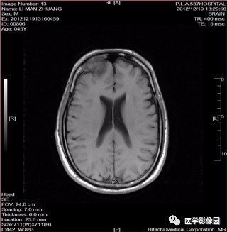 【病例】鼻窦乳头状瘤1例CT及MR影像表现 【病例】鼻窦乳头状瘤1例CT及MR影像表现
