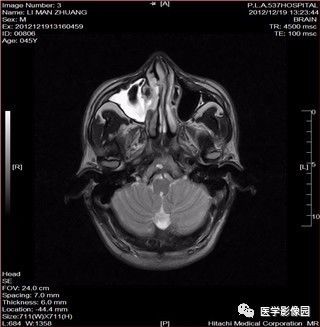 【病例】鼻窦乳头状瘤1例CT及MR影像表现 【病例】鼻窦乳头状瘤1例CT及MR影像表现