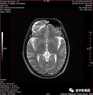 【病例】鼻窦乳头状瘤1例CT及MR影像表现 【病例】鼻窦乳头状瘤1例CT及MR影像表现
