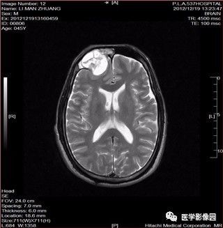 【病例】鼻窦乳头状瘤1例CT及MR影像表现 【病例】鼻窦乳头状瘤1例CT及MR影像表现