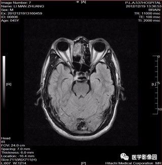 【病例】鼻窦乳头状瘤1例CT及MR影像表现 【病例】鼻窦乳头状瘤1例CT及MR影像表现
