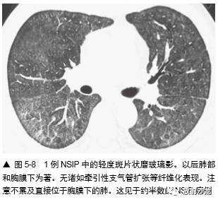 HRCT:磨玻璃影的意义
