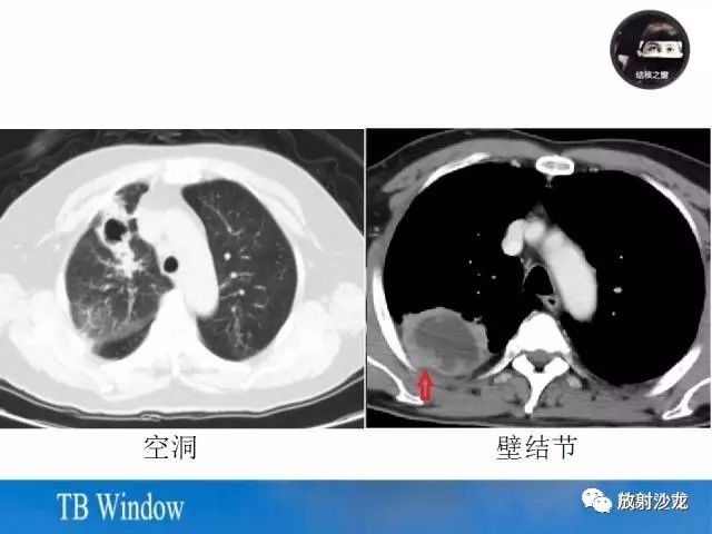 【PPT】周围型肺鳞癌的影像征象及鉴别诊断