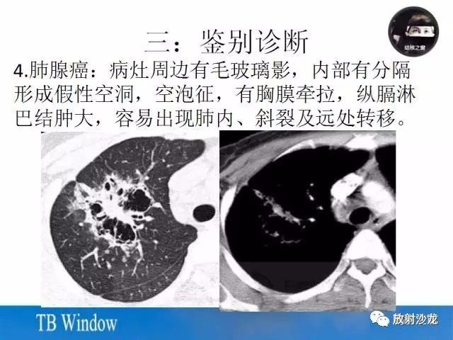 【PPT】周围型肺鳞癌的影像征象及鉴别诊断