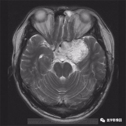 【病例】鞍旁成熟性囊性畸胎瘤1例MR 【病例】鞍旁成熟性囊性畸胎瘤1例MR