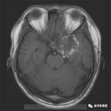【病例】鞍旁成熟性囊性畸胎瘤1例MR 【病例】鞍旁成熟性囊性畸胎瘤1例MR