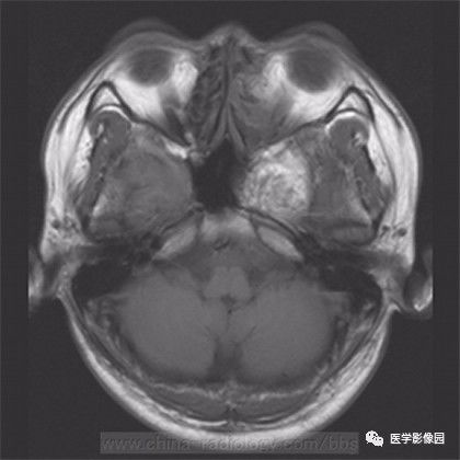 【病例】鞍旁成熟性囊性畸胎瘤1例MR 【病例】鞍旁成熟性囊性畸胎瘤1例MR
