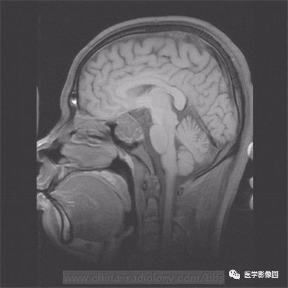 【病例】鞍旁成熟性囊性畸胎瘤1例MR 【病例】鞍旁成熟性囊性畸胎瘤1例MR