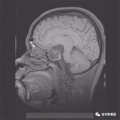 【病例】鞍旁成熟性囊性畸胎瘤1例MR 【病例】鞍旁成熟性囊性畸胎瘤1例MR