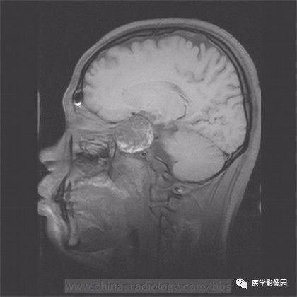 【病例】鞍旁成熟性囊性畸胎瘤1例MR 【病例】鞍旁成熟性囊性畸胎瘤1例MR