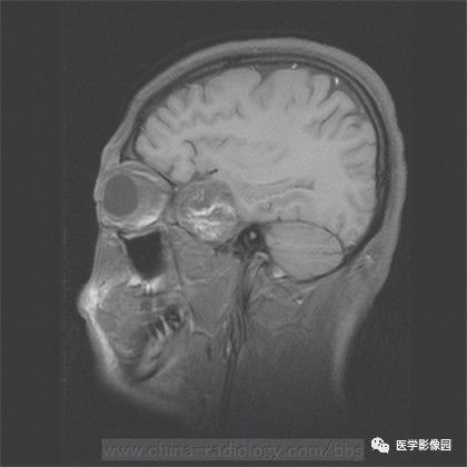 【病例】鞍旁成熟性囊性畸胎瘤1例MR 【病例】鞍旁成熟性囊性畸胎瘤1例MR