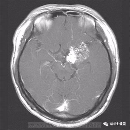 【病例】鞍旁成熟性囊性畸胎瘤1例MR 【病例】鞍旁成熟性囊性畸胎瘤1例MR