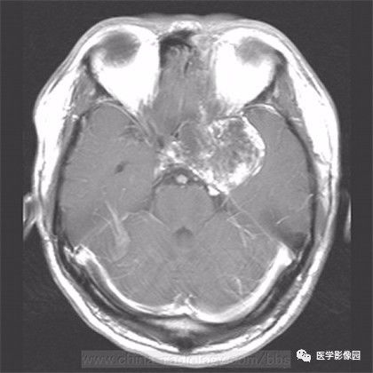 【病例】鞍旁成熟性囊性畸胎瘤1例MR 【病例】鞍旁成熟性囊性畸胎瘤1例MR