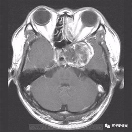 【病例】鞍旁成熟性囊性畸胎瘤1例MR 【病例】鞍旁成熟性囊性畸胎瘤1例MR
