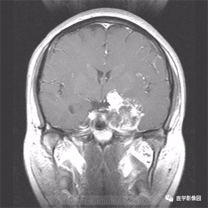 【病例】鞍旁成熟性囊性畸胎瘤1例MR 【病例】鞍旁成熟性囊性畸胎瘤1例MR