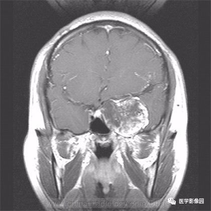 【病例】鞍旁成熟性囊性畸胎瘤1例MR 【病例】鞍旁成熟性囊性畸胎瘤1例MR